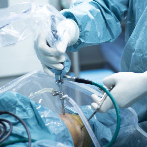 arthroscopy