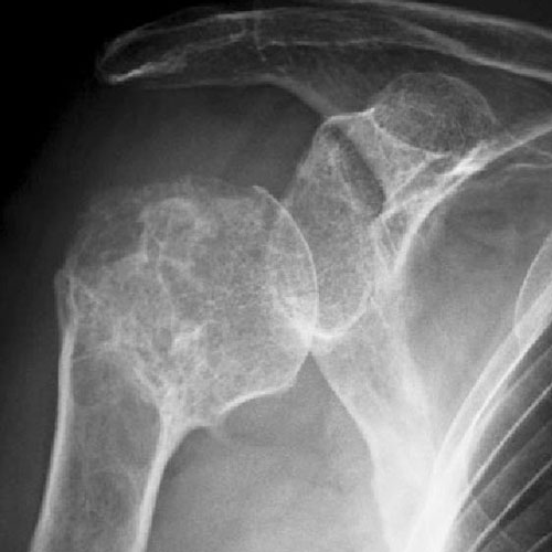 Malunion treatment