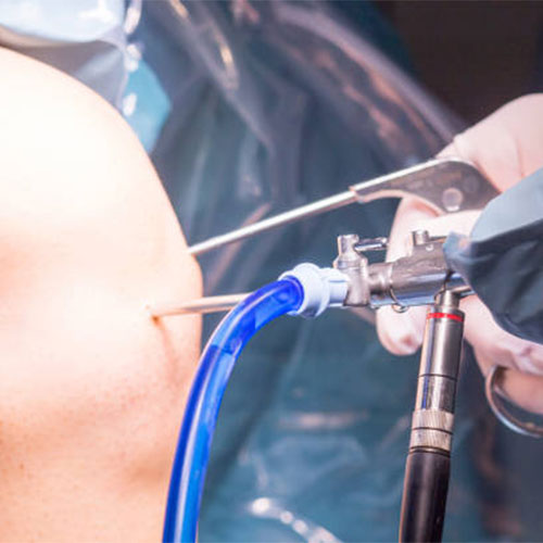 Knee arthroscopy